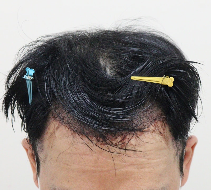 2. 수술후_1일_1.JPG