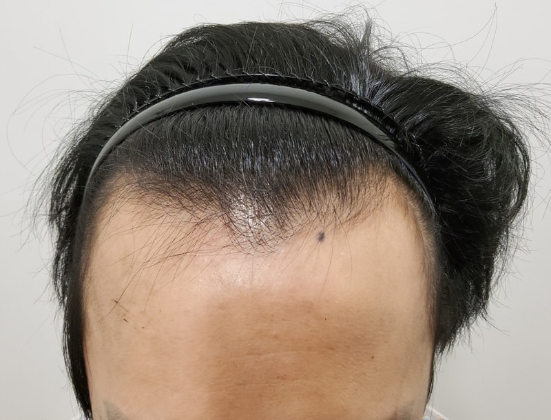 안녕하세요~ 비절개 모발이식 받고 3개월 지났습니다.