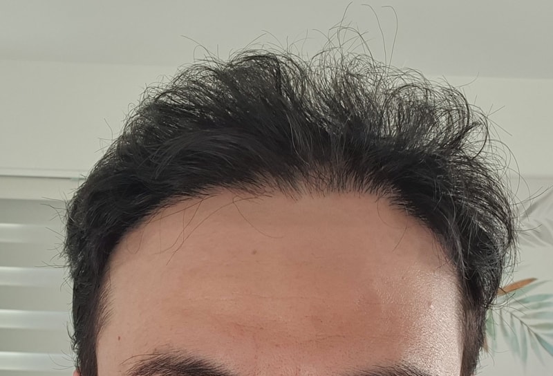 4. 수술후_6개월_셀카_1.jpg