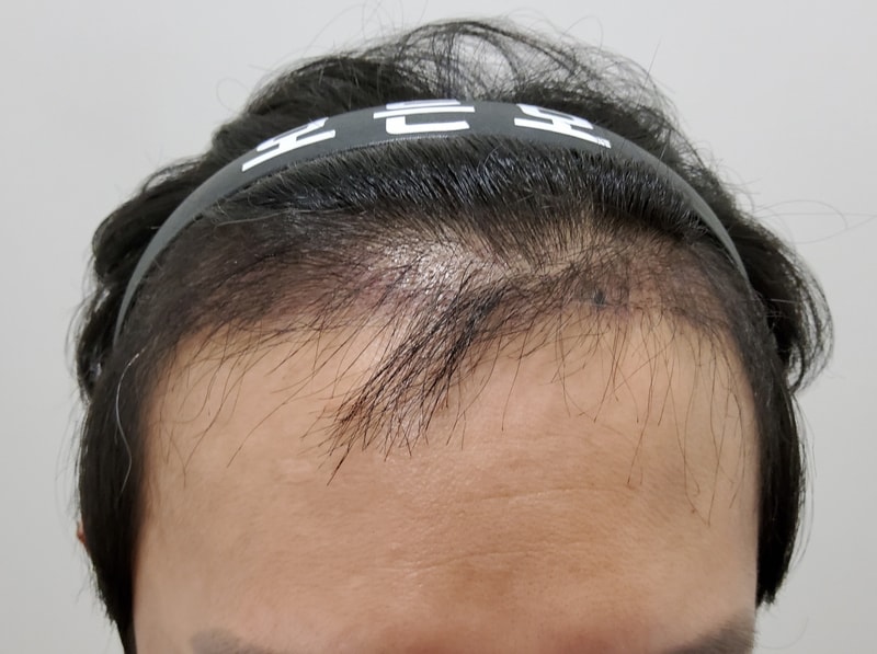 3. 수술후_3개월_1.jpg