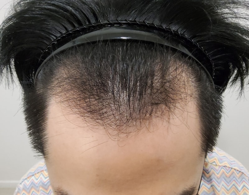 1. 수술전_1.jpg