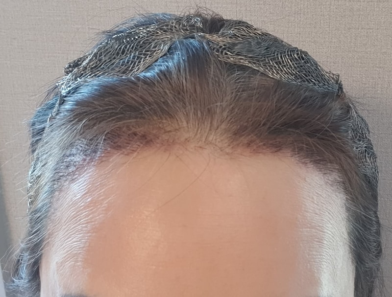 2. 수술후_2주_셀카1.jpg