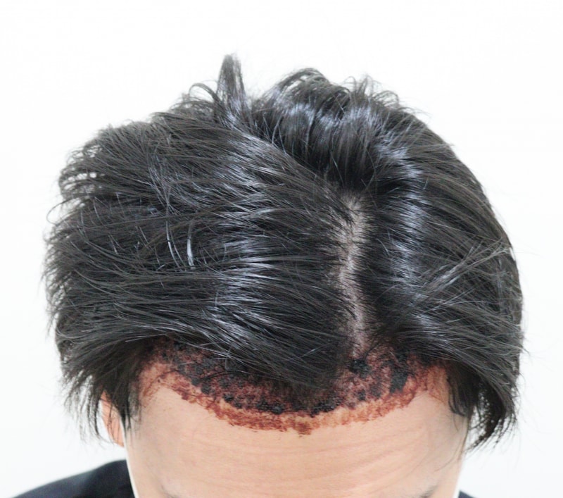 2. 수술후_1일.JPG