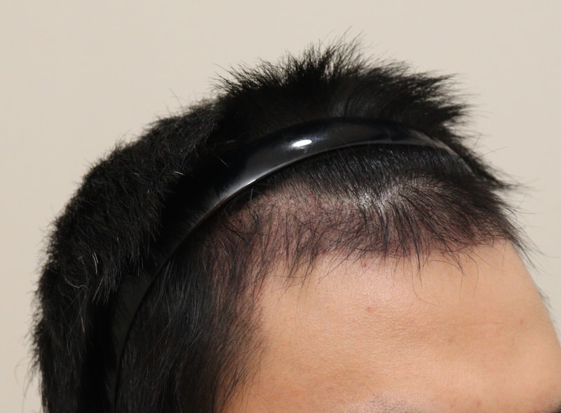 4. 수술후_3개월_3.JPG