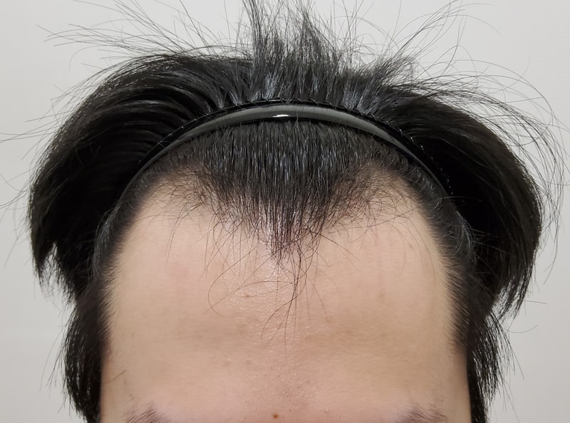 It's the second week of non-cut hair transplantation ^^~