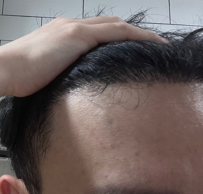 4. 수술후_6개월_셀카2.jpg