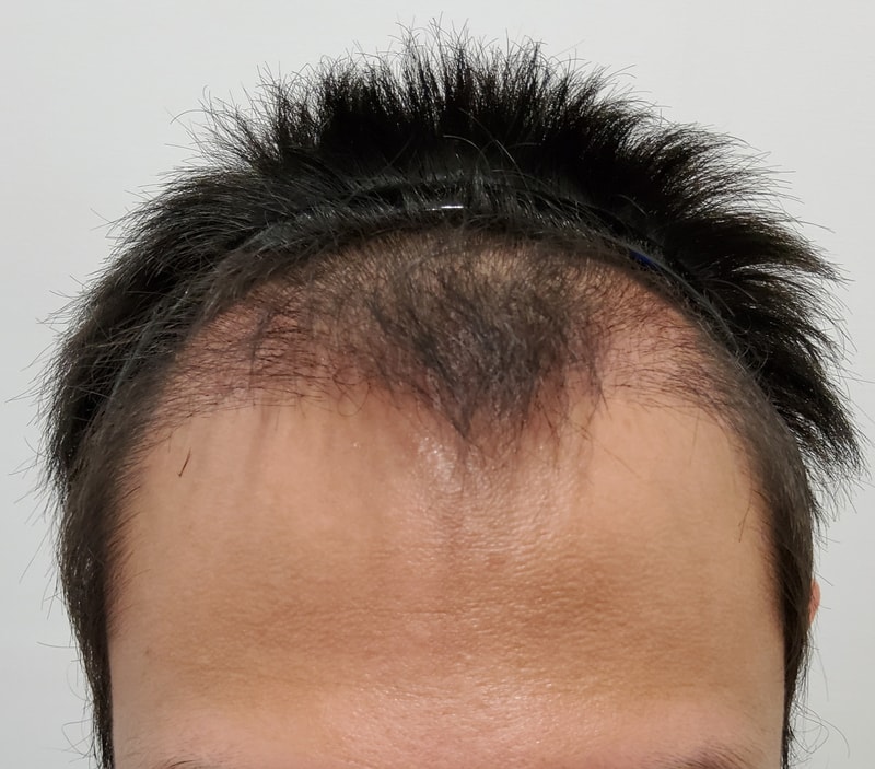 3. 수술후_3개월_1.jpg