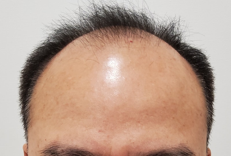 It's been two weeks since the hair transplant ^^