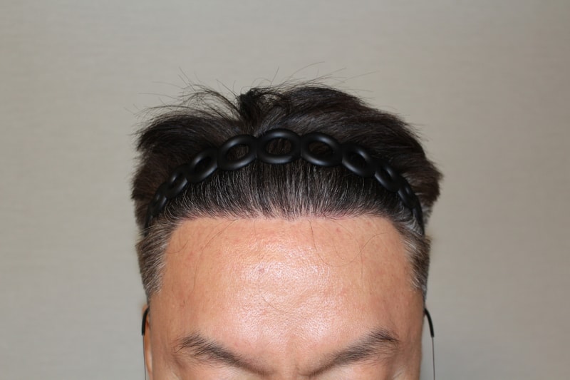 7개월 경과_정면.jpg