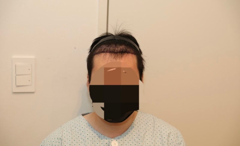 [뉴헤어]뉴헤어(강남) 모발이식(절개) 4000모 1년차 후기