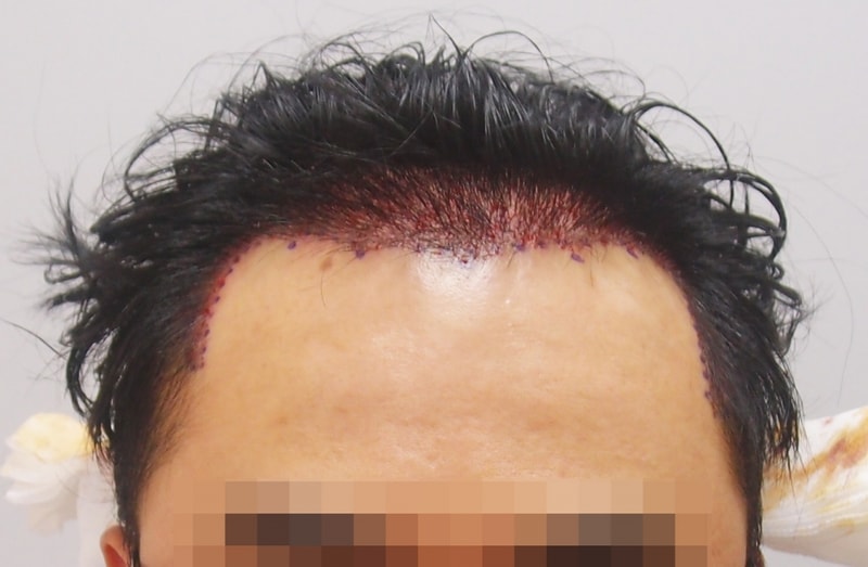 수술직후1.jpg