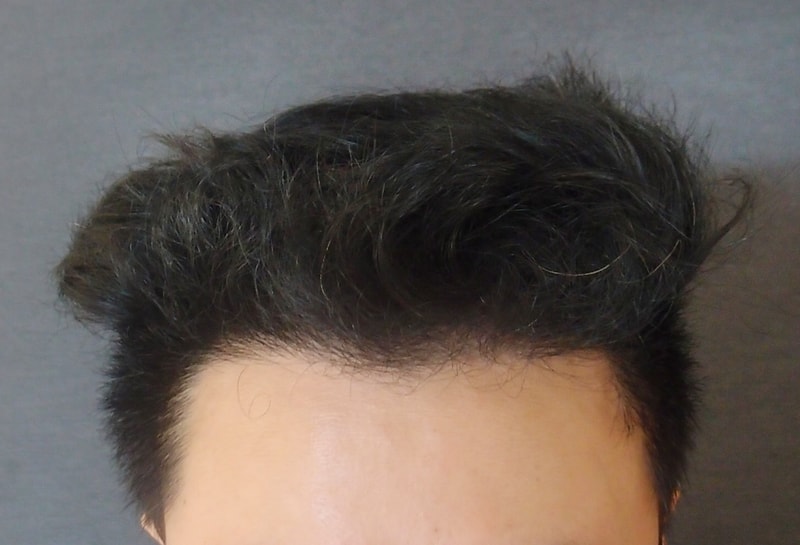 수술후1.jpg