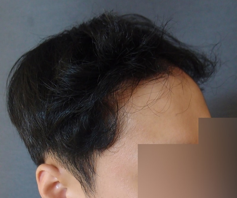 수술후1년04.jpg