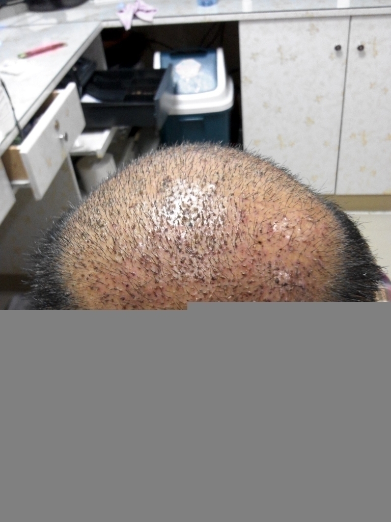 4차수술후 5일째 되던날.jpg