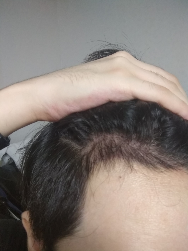 이식 8일째인데 어떤가요?