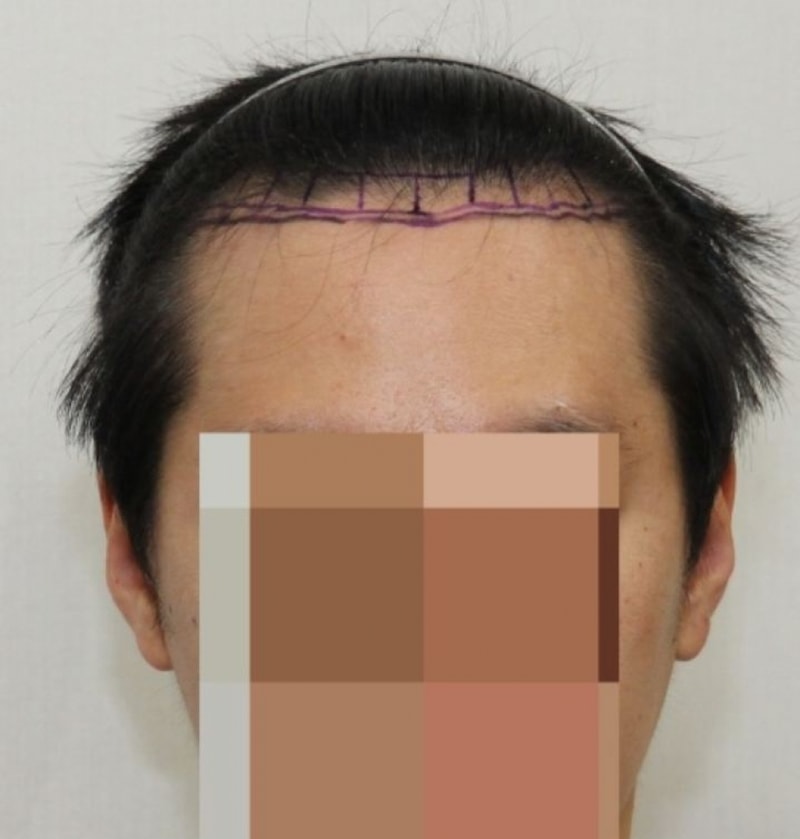 뉴헤어 절개 6개월차입니다.