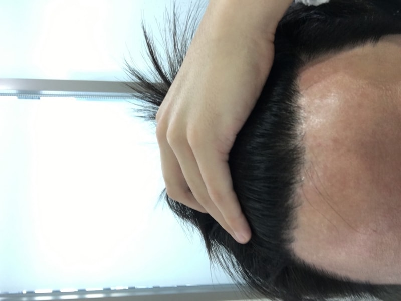 절개 3878모 수술 12개월