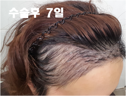 5. 수술후 7일.png