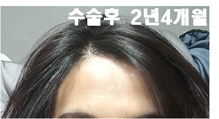 9. 수술후 2년4개월.png