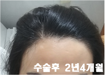 10. 수술후 2년4개월.png