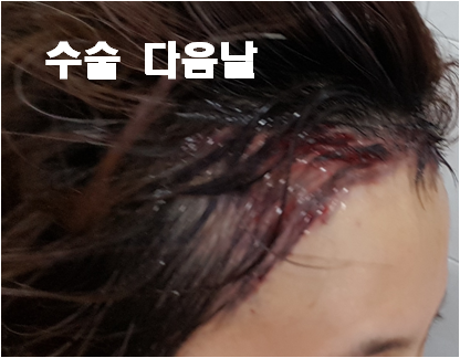 3. 수술 다음날.png