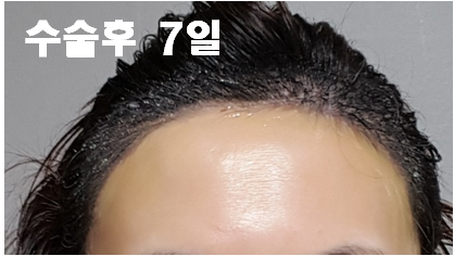 4. 수술후 7일.png