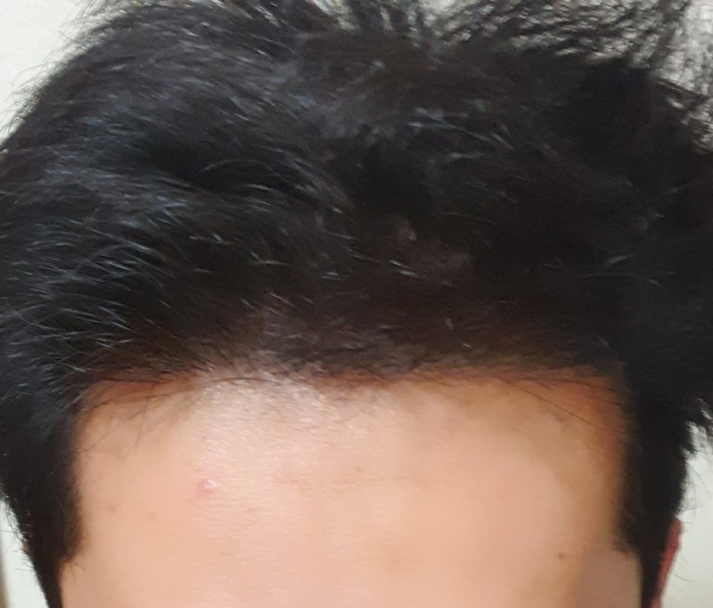 약 16개월 차 비절개 모발이식 후기