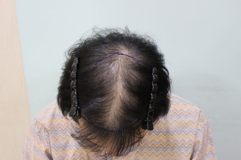 수술전 디자인 (2).JPG