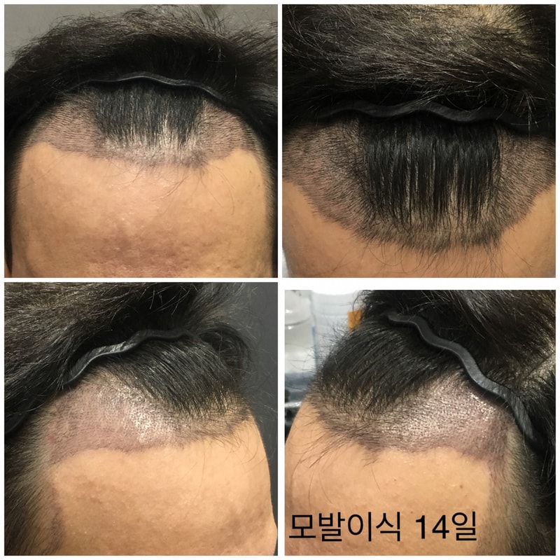 모발이식 후 14일 경과 입니다.