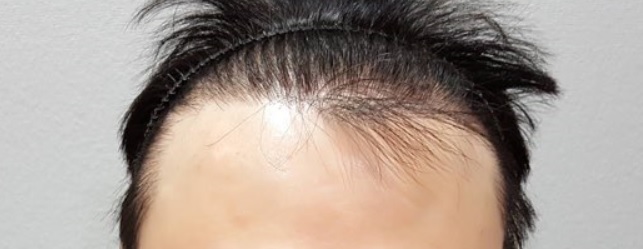 수술 전 헤어라인.jpg