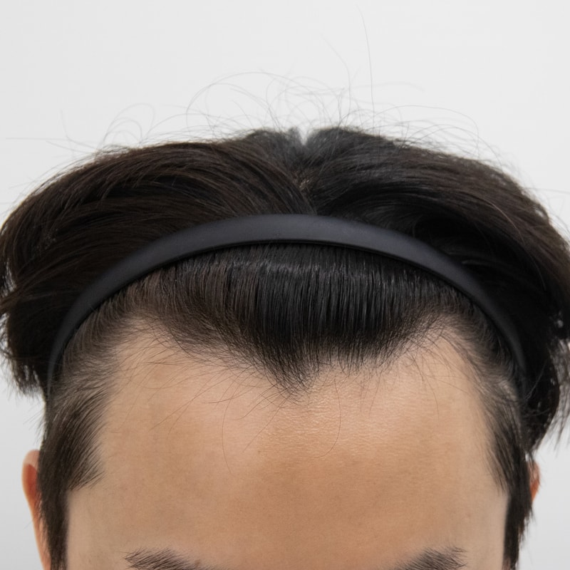 부산 비절개 다이아몬드 M자 슬릿 이식 1년 이후_맘모스헤어라인의원