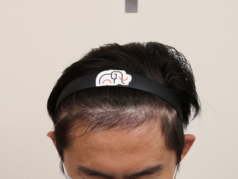 Busan Hair Transplantation Slit Method Mammoth Hair Restoration Center M-shaped Surgery 4 Months After