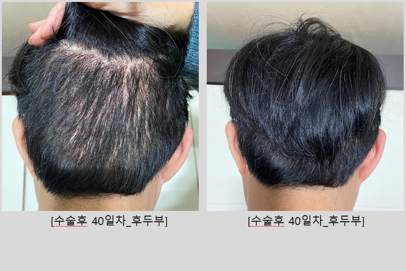 후두부_40일경과.jpg