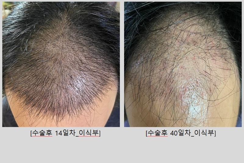 이식부_40일경과.jpg