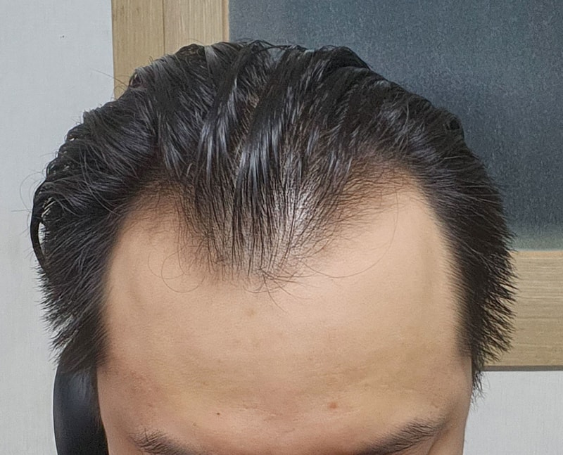 절개, 비절개 혼용 무삭발로 4500모 진행했습니다.