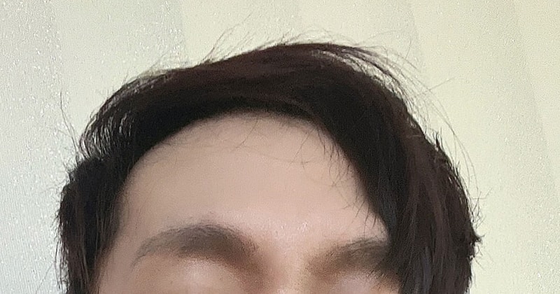 수술후-머리.jpg