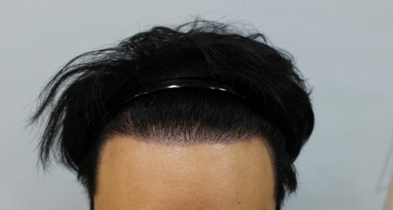 크기변환_2차수술 10일후.png