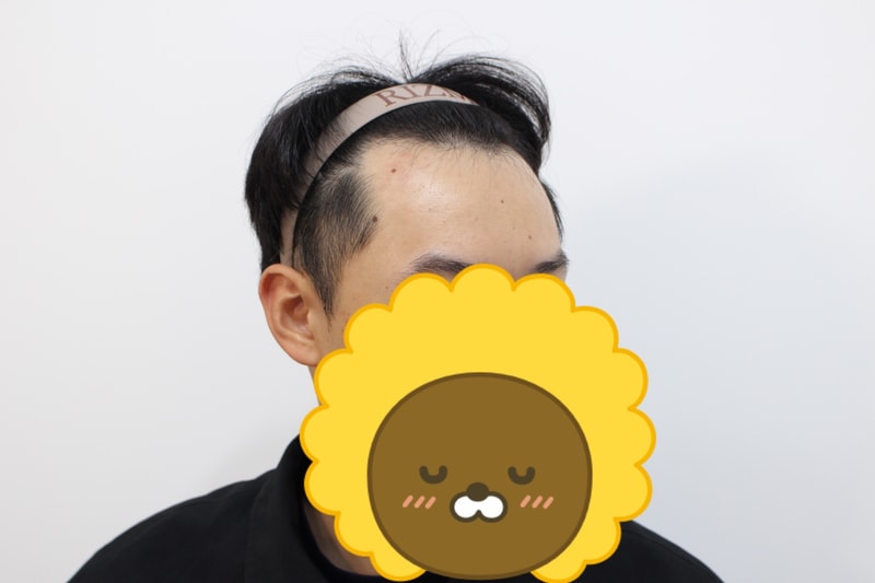 모발이식 8개월 후기