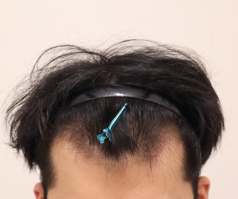 비절개 M자 모발이식 수술 직후 후기입니다.