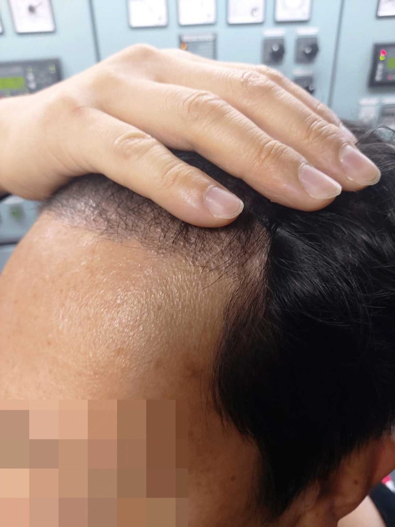 [크기변환]수술-4개월차.jpg