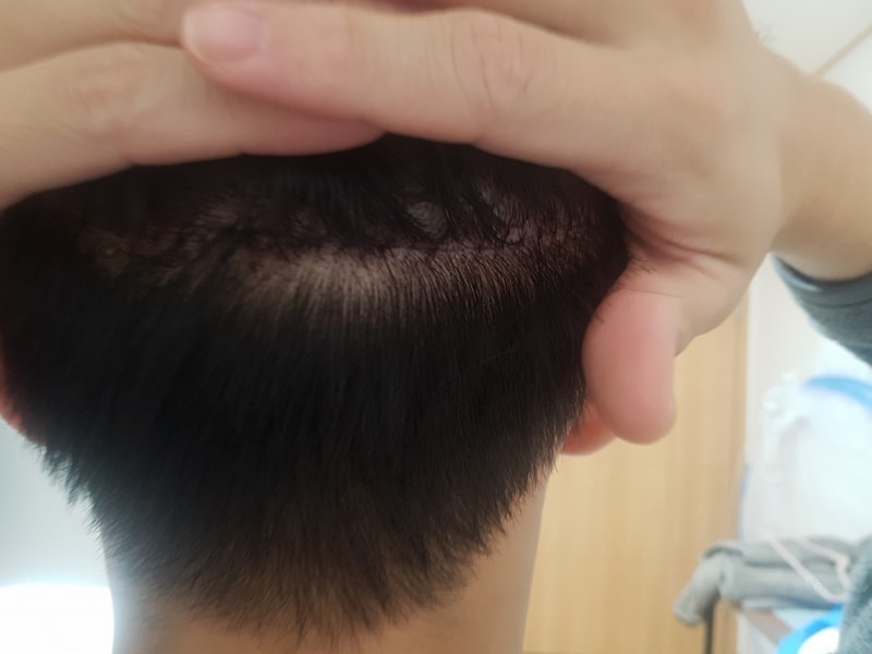 후두부2.jpg
