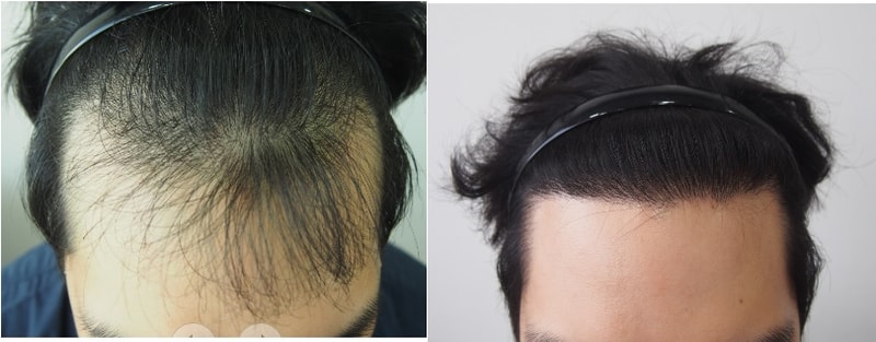 수술전후비교 앞.jpg