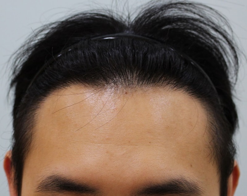 수술후 1년 (3).JPG