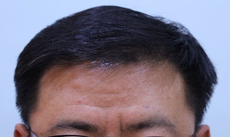수술후8개월 (13).JPG