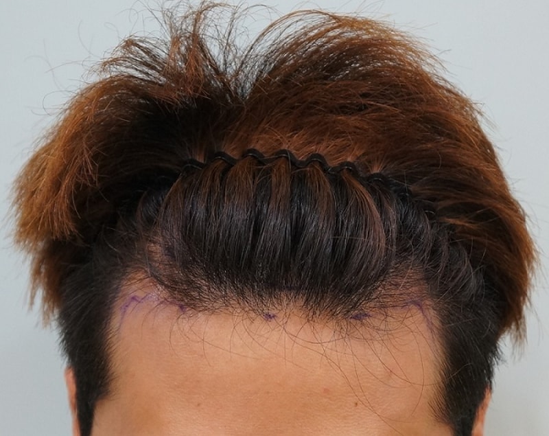 수술전 디자인 (9).JPG