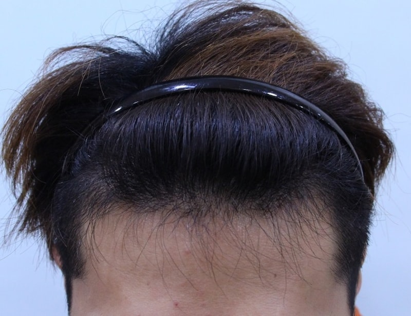 수술 4개월째 (1).JPG