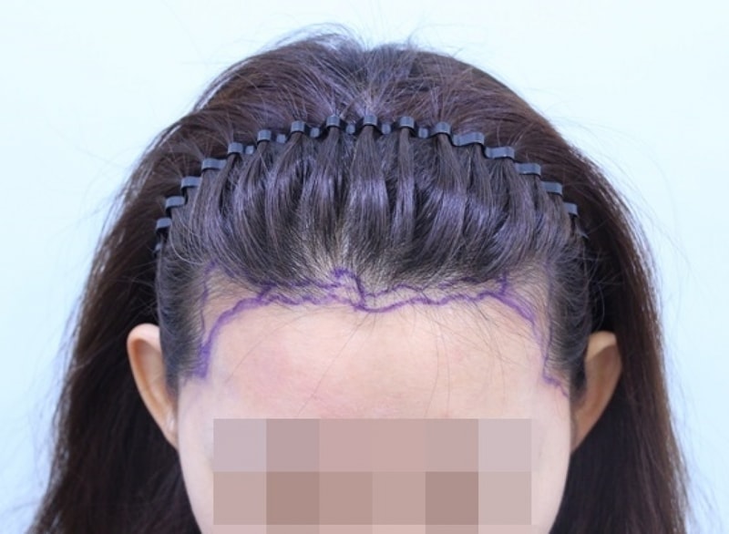 수술전디자인 (4).JPG