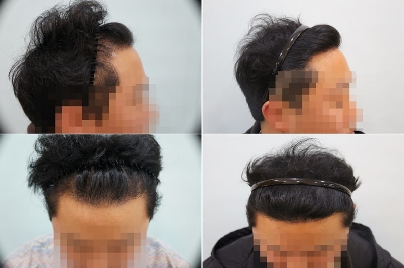 수술전 (4)-tile.jpg