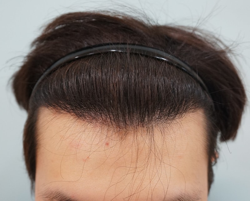 수술 후 정면.jpg