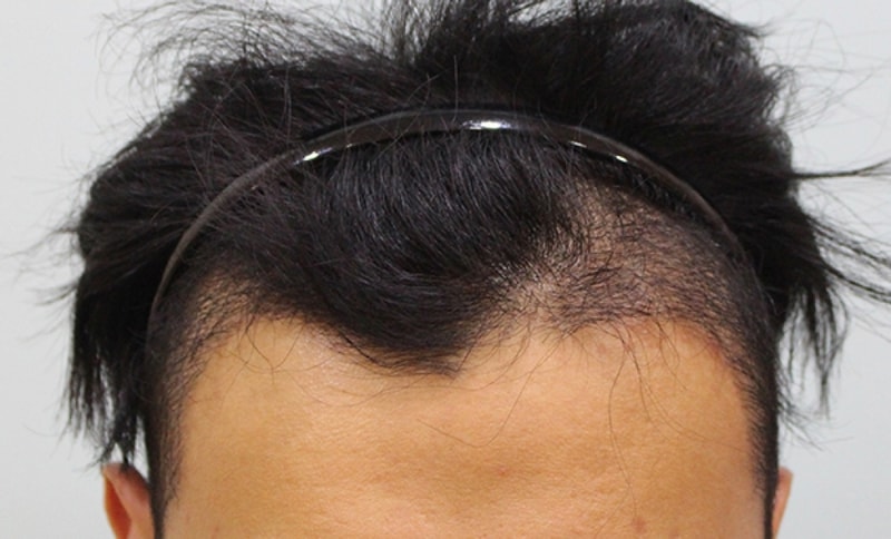수술 3개월 후 정면_01.jpg
